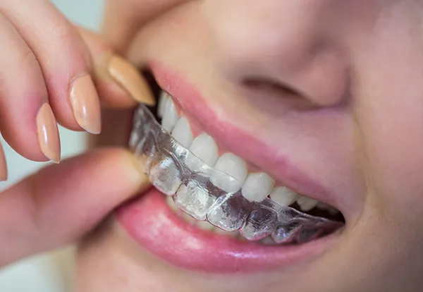 diş tedavileri şeffaf plak